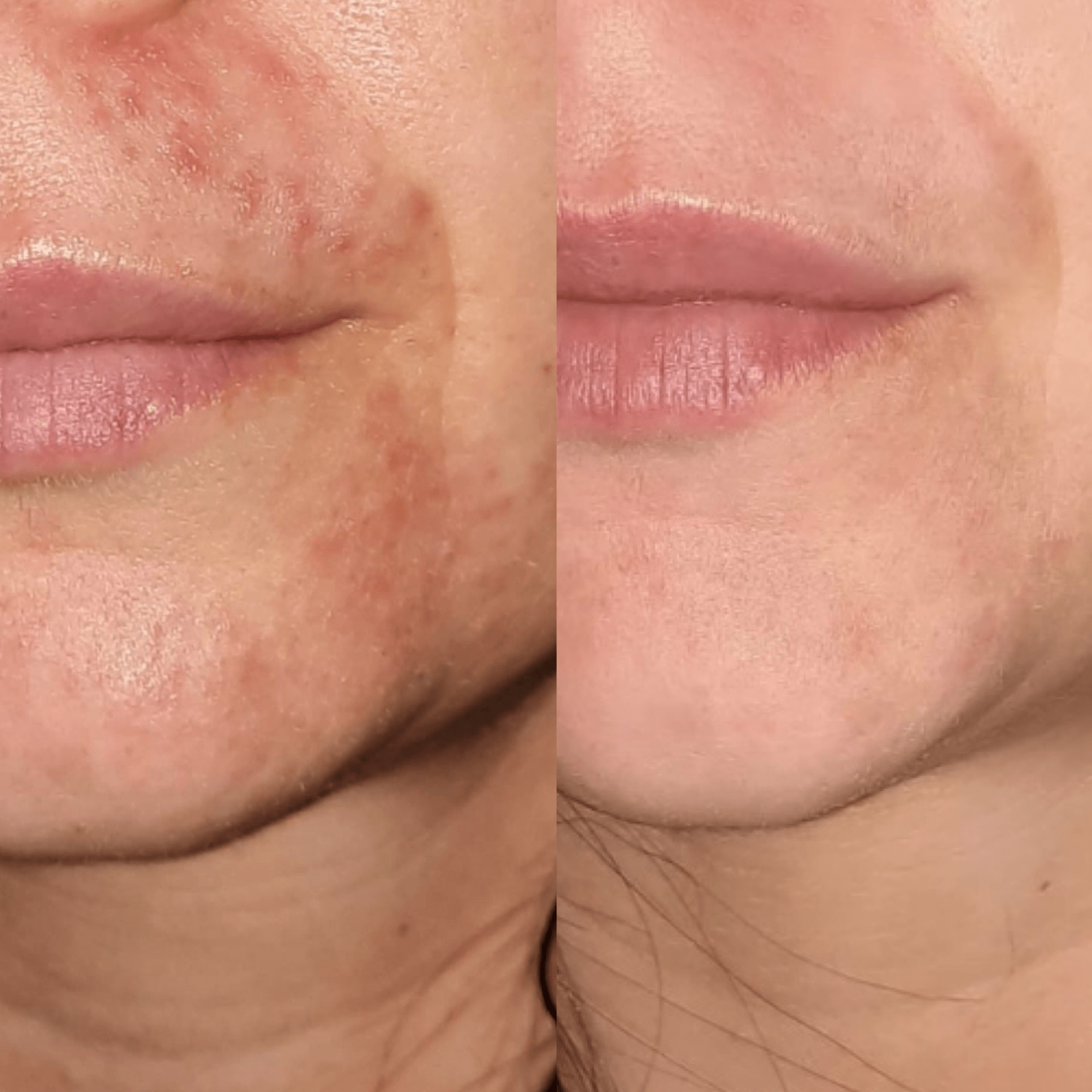 Calm Cream- Best Natural Cream For Dry, Itchy & Sensitive Skin